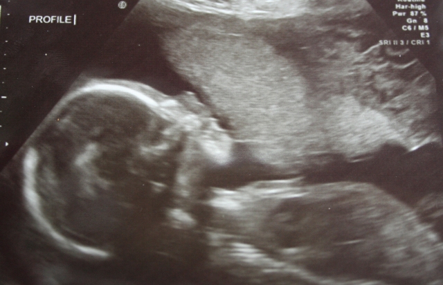 Ultrasound at 19 weeks. You sucking...